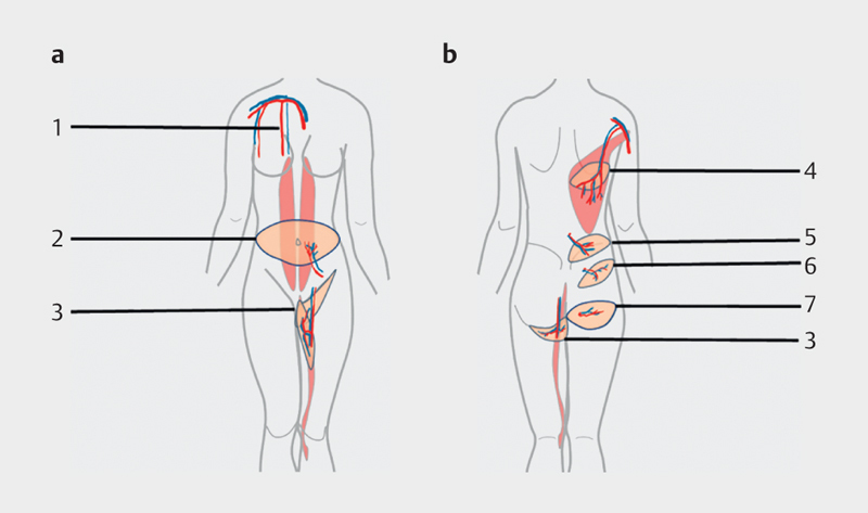 [Update and Trends in Breast Reconstruction After Mastectomy].