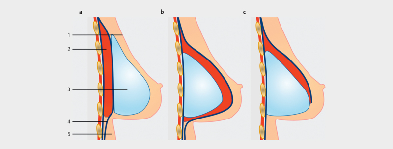 [Update and Trends in Breast Reconstruction After Mastectomy].