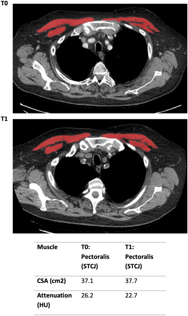 Analytic Morphomics in Myositis-Related Interstitial Lung Disease.