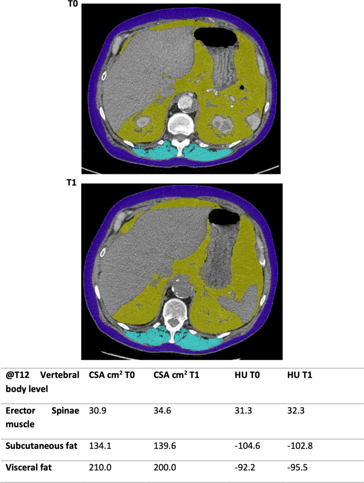 Analytic Morphomics in Myositis-Related Interstitial Lung Disease.