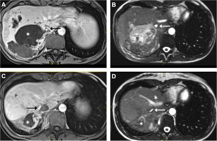 Vascular pathology in patients with alveolar echinococcosis: framework for assessment and clinical management - a retrospective case series.