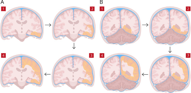 Clinicoradiologic Criteria for the Diagnosis of Stroke-like Episodes in MELAS.