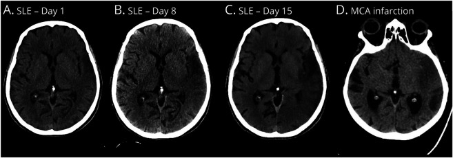 Clinicoradiologic Criteria for the Diagnosis of Stroke-like Episodes in MELAS.