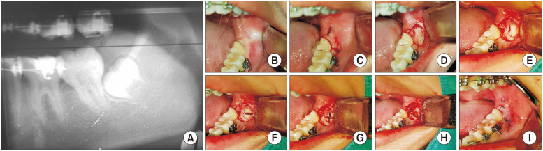 Surgical removal of third molars in a young adult: review of indications and surgical techniques.