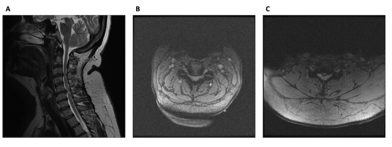 Rapidly Deteriorating Degenerative Cervical Myelopathy Following Ventricular Shunt Revision for Hydrocephalus: Case Report.