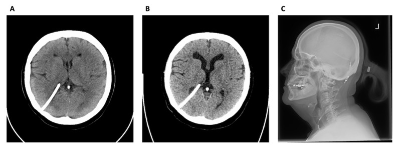 Rapidly Deteriorating Degenerative Cervical Myelopathy Following Ventricular Shunt Revision for Hydrocephalus: Case Report.