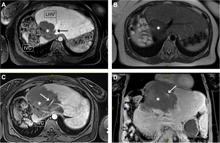 Vascular pathology in patients with alveolar echinococcosis: framework for assessment and clinical management - a retrospective case series.