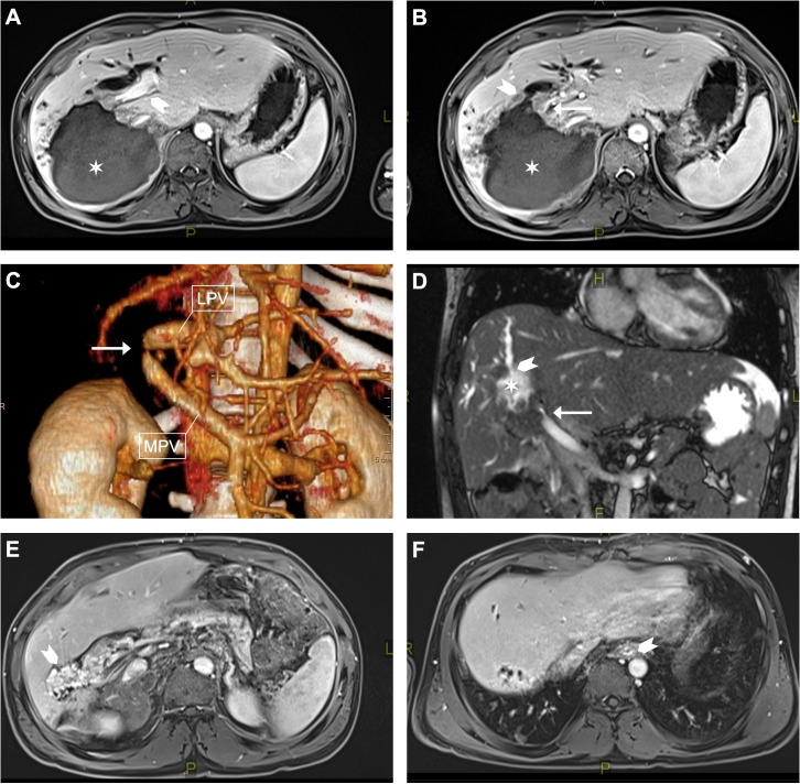 Vascular pathology in patients with alveolar echinococcosis: framework for assessment and clinical management - a retrospective case series.