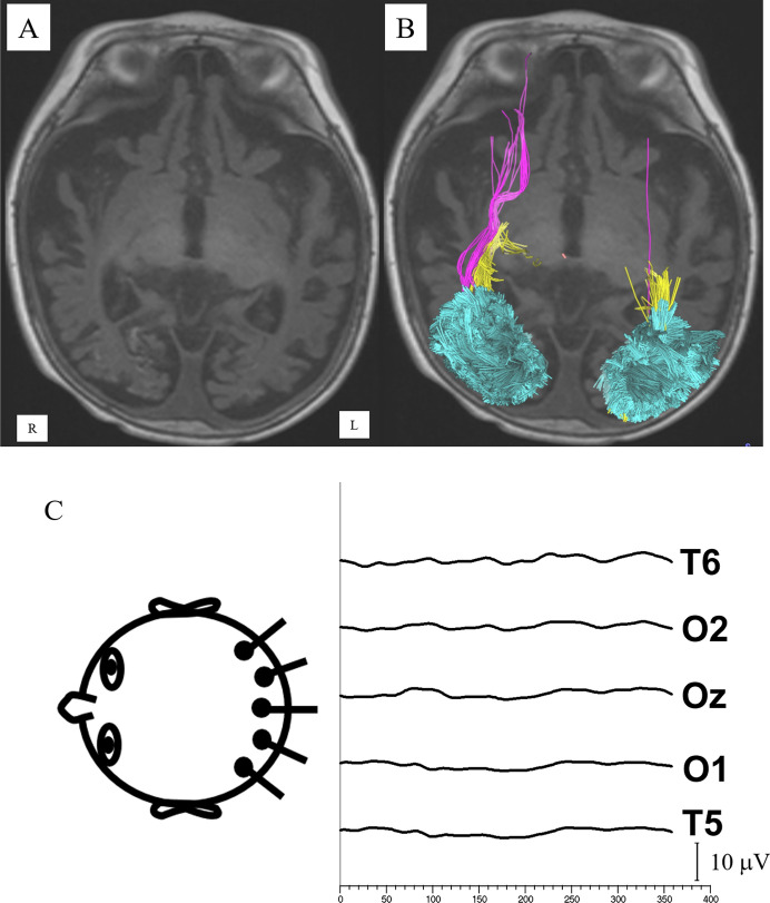 Pediatric abusive head trauma: visual outcomes, evoked potentials, diffusion tensor imaging, and relationships to retinal hemorrhages.