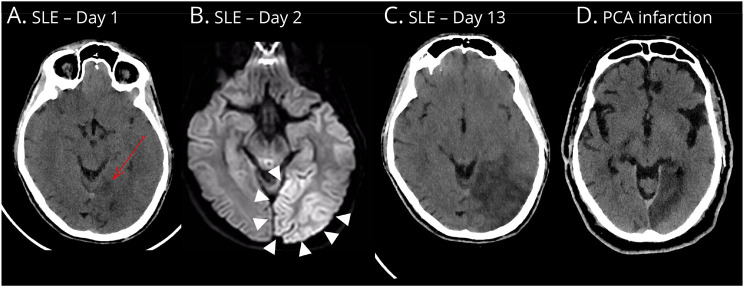 Clinicoradiologic Criteria for the Diagnosis of Stroke-like Episodes in MELAS.