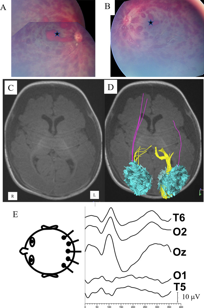 Pediatric abusive head trauma: visual outcomes, evoked potentials, diffusion tensor imaging, and relationships to retinal hemorrhages.