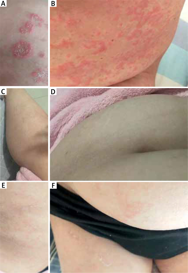 Rapid response of spesolimab in biologics - failure patient with generalized pustular psoriasis flare.