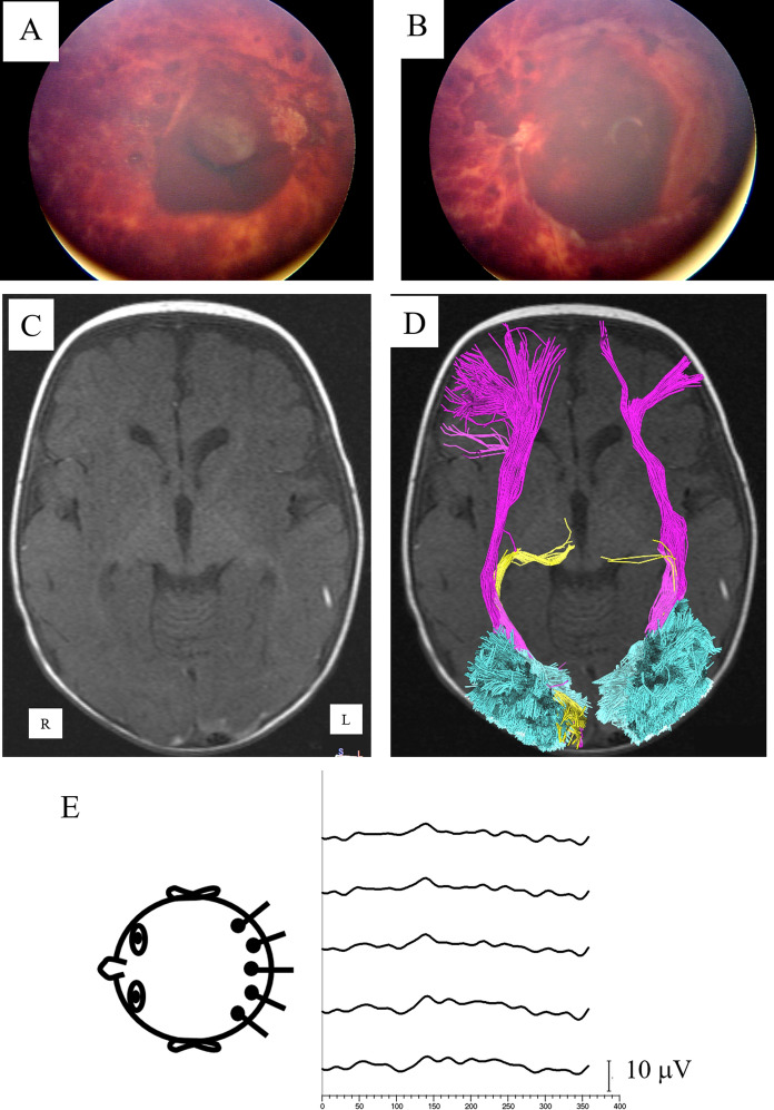 Pediatric abusive head trauma: visual outcomes, evoked potentials, diffusion tensor imaging, and relationships to retinal hemorrhages.