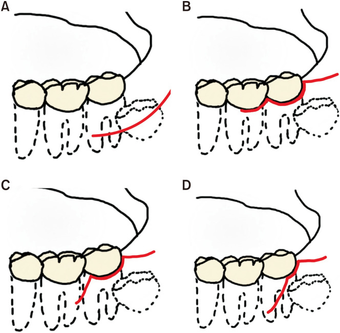 Surgical removal of third molars in a young adult: review of indications and surgical techniques.