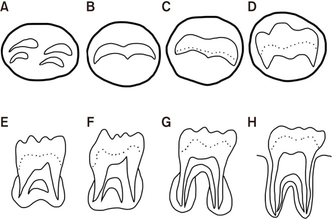 Surgical removal of third molars in a young adult: review of indications and surgical techniques.