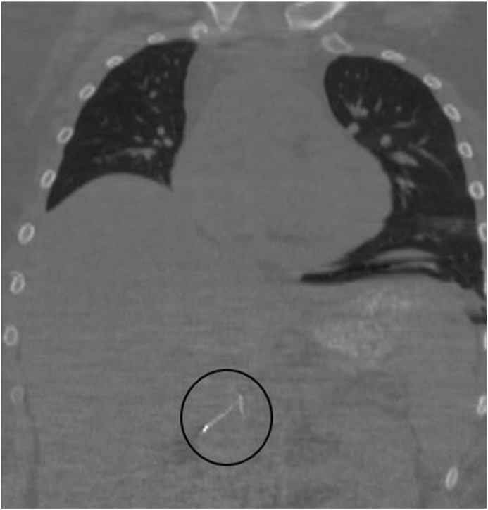 Inferior vena cava filter misplacement with SVC perforation