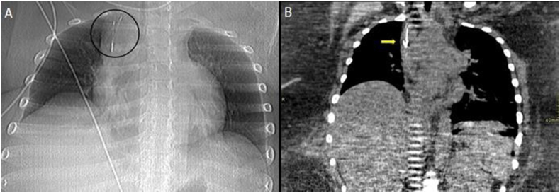 Inferior vena cava filter misplacement with SVC perforation