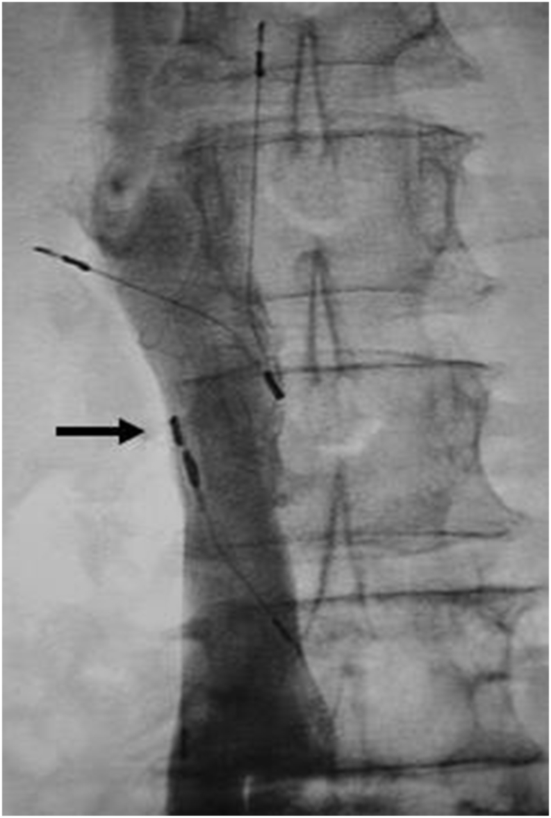 Inferior vena cava filter misplacement with SVC perforation