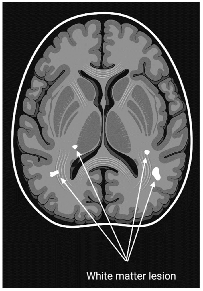 Migraine: Advances in the Pathogenesis and Treatment.