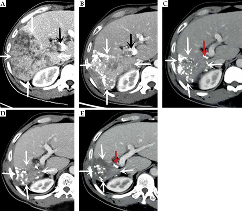 TACE combined with portal particle implantation in a case of stage IIIa primary hepatocellular carcinoma treated with sequential anlotinib.