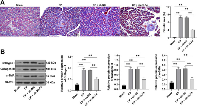 The Kruppel-like factor 4-signal transducer and activator of transcription 5A axis promotes pancreatic fibrosis in mice with caerulein-induced chronic pancreatitis.