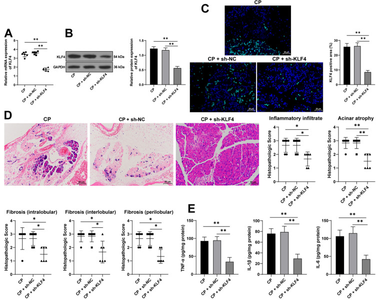 The Kruppel-like factor 4-signal transducer and activator of transcription 5A axis promotes pancreatic fibrosis in mice with caerulein-induced chronic pancreatitis.