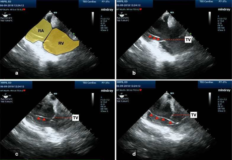 Transesophageal echocardiography (TEE)-guided transvenous pacing (TVP) in emergency department.