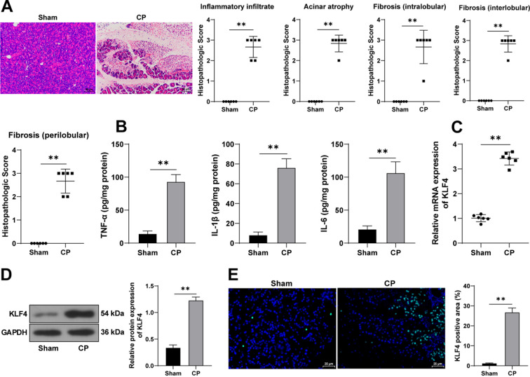 The Kruppel-like factor 4-signal transducer and activator of transcription 5A axis promotes pancreatic fibrosis in mice with caerulein-induced chronic pancreatitis.