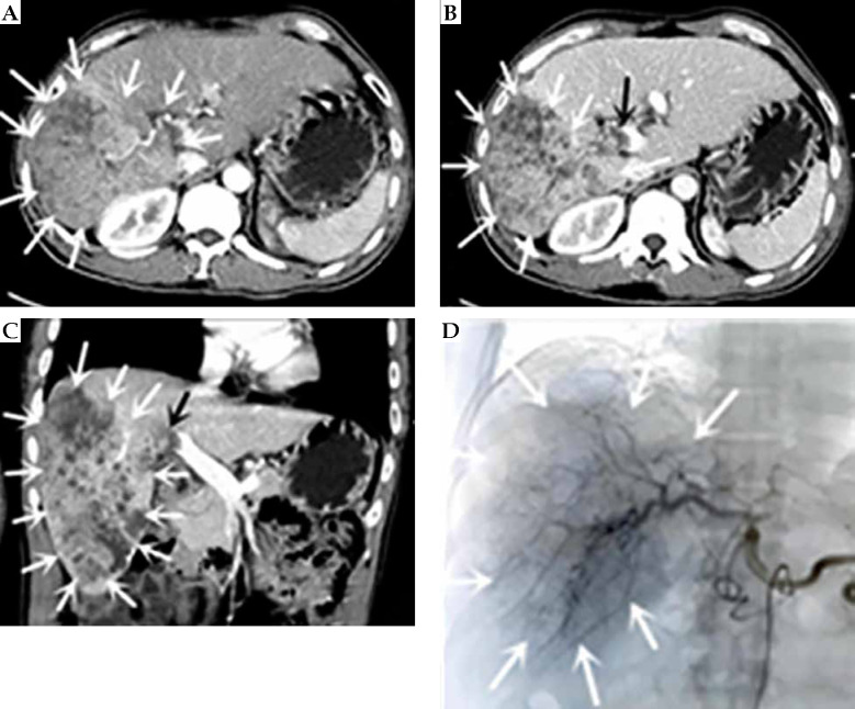 TACE combined with portal particle implantation in a case of stage IIIa primary hepatocellular carcinoma treated with sequential anlotinib.