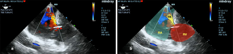 Transesophageal echocardiography (TEE)-guided transvenous pacing (TVP) in emergency department.