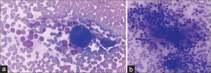 Diagnostic clues for hyalinizing trabecular tumor on fine needle aspiration cytology.