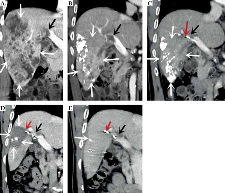 TACE combined with portal particle implantation in a case of stage IIIa primary hepatocellular carcinoma treated with sequential anlotinib.