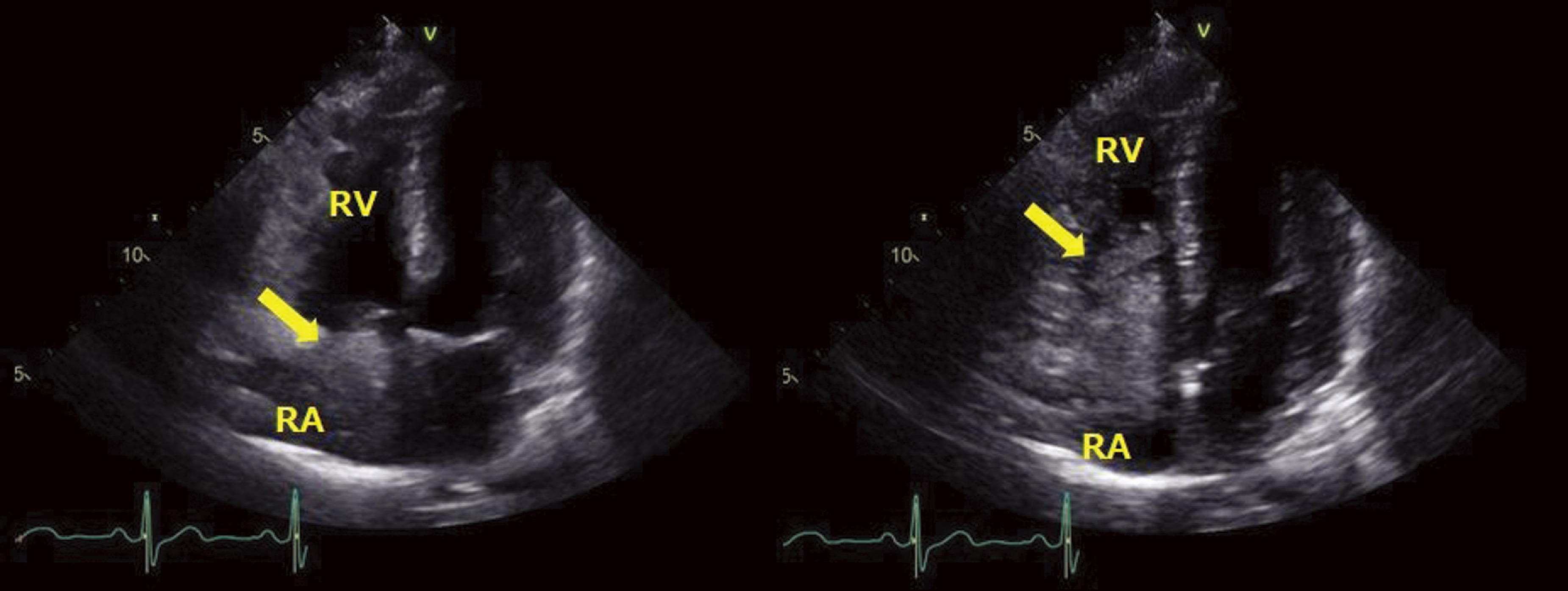 Complete Resection of a Cavoatrial Metastatic Liposarcoma under Hypothermic Circulatory Arrest.