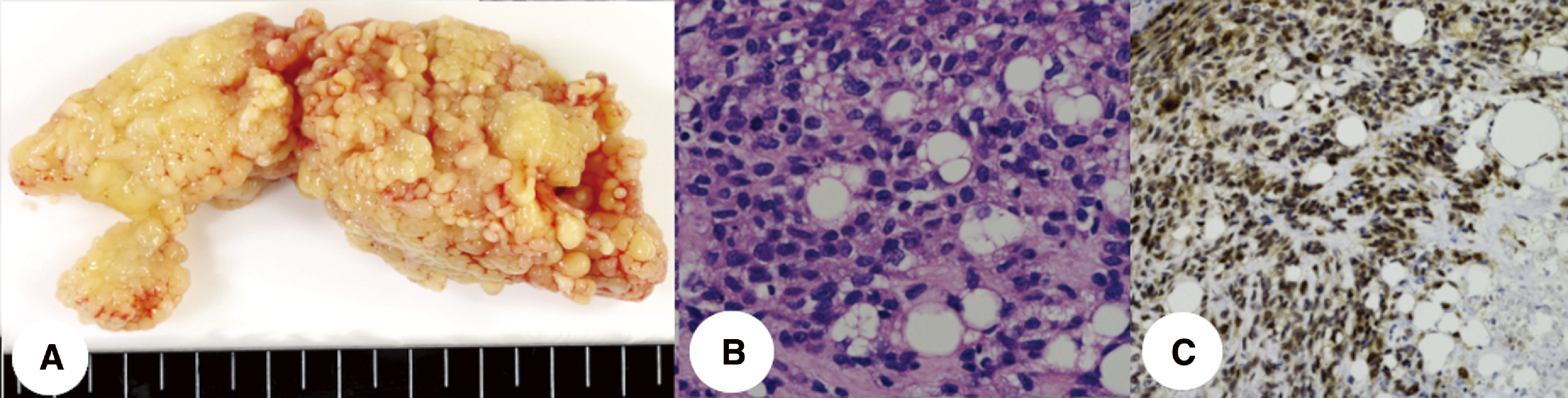 Complete Resection of a Cavoatrial Metastatic Liposarcoma under Hypothermic Circulatory Arrest.