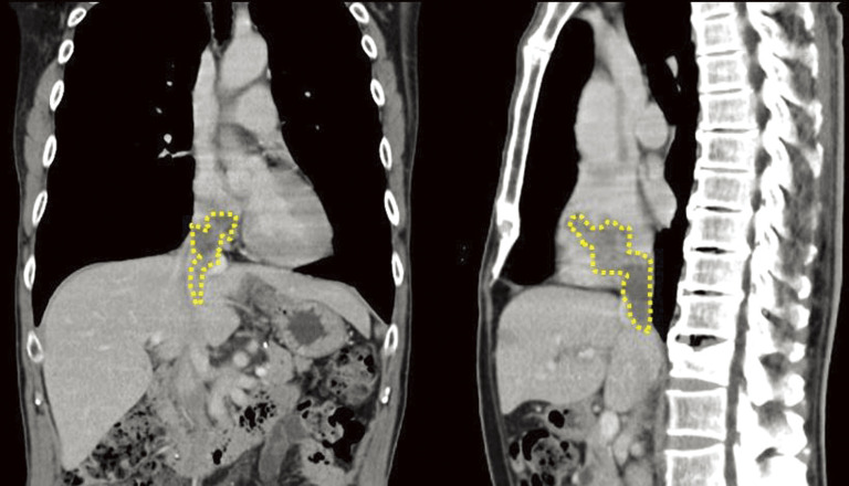 Complete Resection of a Cavoatrial Metastatic Liposarcoma under Hypothermic Circulatory Arrest.