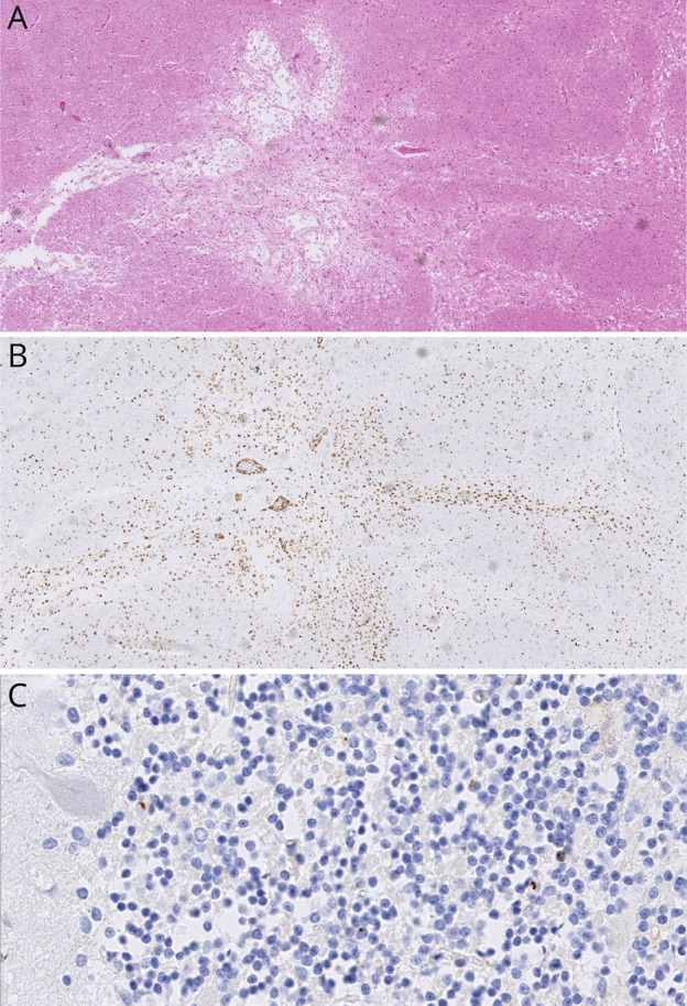 Systemic Capillary Leak Syndrome With Cerebral Involvement in a <i>C9orf72</i> Expansion Carrier: Case Report and Review of the Literature.