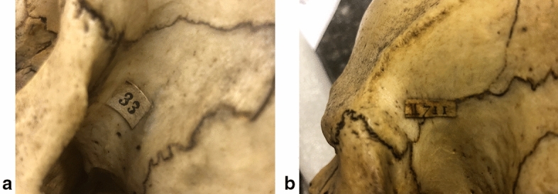 The Shelf Life of Skulls: Anthropology and 'race' in the Vrolik Craniological Collection.