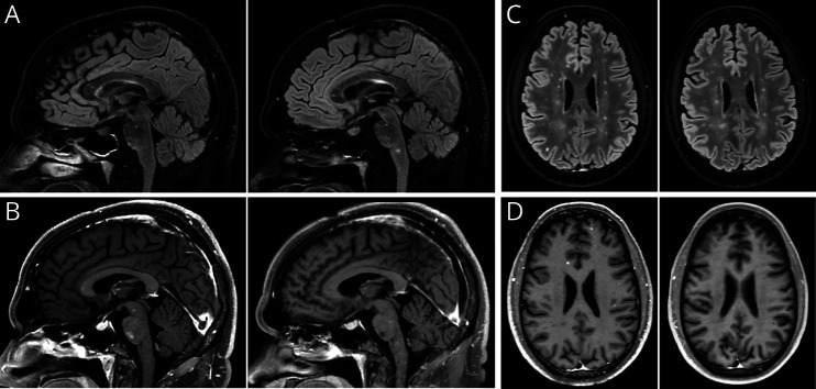 Systemic Capillary Leak Syndrome With Cerebral Involvement in a <i>C9orf72</i> Expansion Carrier: Case Report and Review of the Literature.