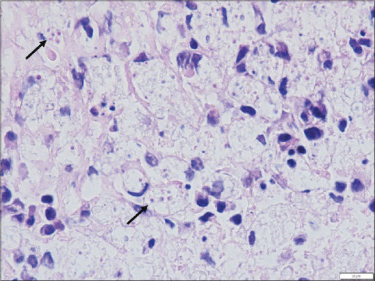 Hemophagocytic Lymphohistiocytosis due to Disseminated Histoplasmosis in a Patient with HIV Infection.