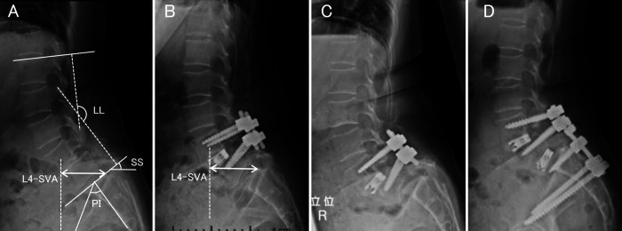 Bilateral L5 pedicle fracture with L5-S1 spondylolisthesis after single-level L4-5 posterior lumbar interbody fusion: illustrative case.