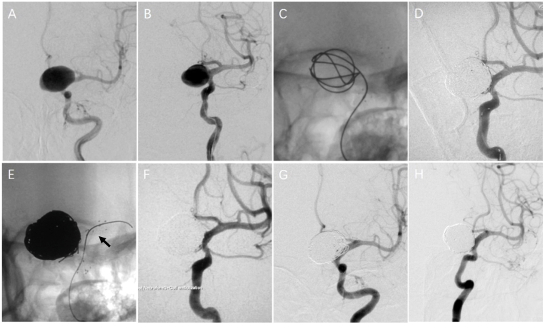 Stent-assisted coiling of intracranial carotid ophthalmic segment aneurysm segment aneurysms: Long-term follow-up from a single center