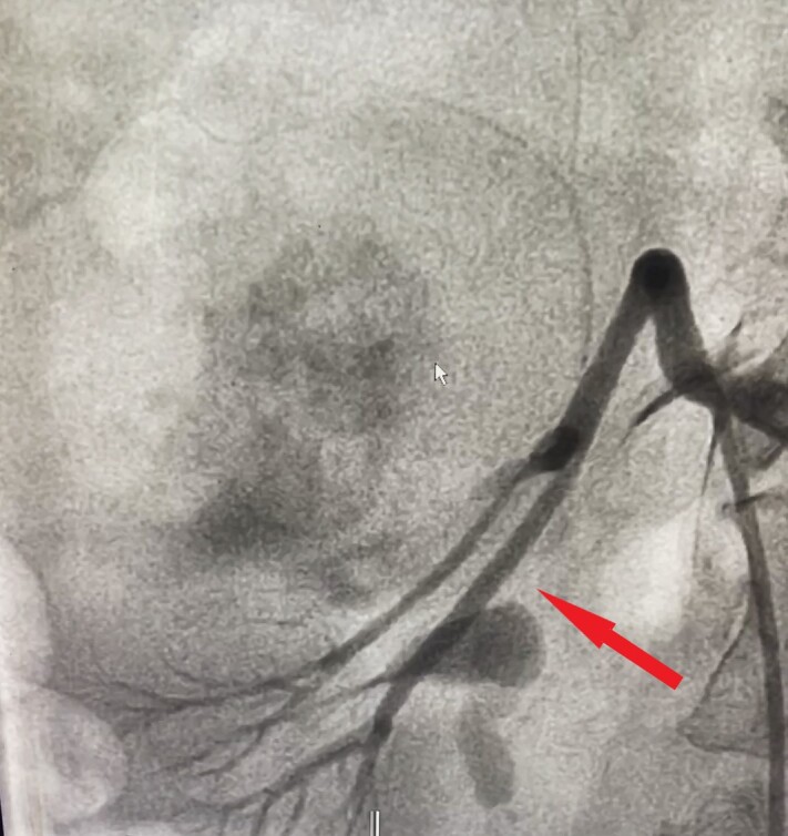 Endovascular management of bilateral renal angiomyolipoma in a perimenopausal woman.