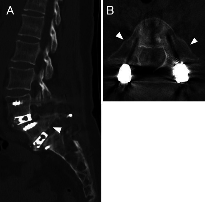 Bilateral L5 pedicle fracture with L5-S1 spondylolisthesis after single-level L4-5 posterior lumbar interbody fusion: illustrative case.
