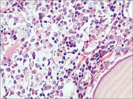 Hemophagocytic Lymphohistiocytosis due to Disseminated Histoplasmosis in a Patient with HIV Infection.