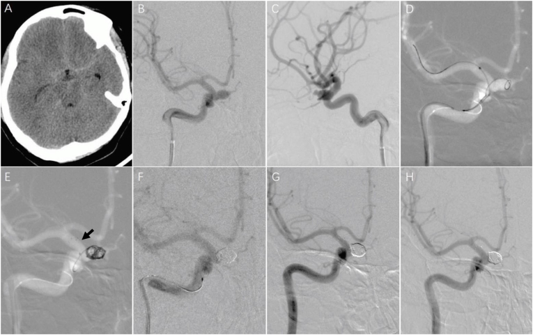 Stent-assisted coiling of intracranial carotid ophthalmic segment aneurysm segment aneurysms: Long-term follow-up from a single center