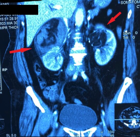 Endovascular management of bilateral renal angiomyolipoma in a perimenopausal woman.