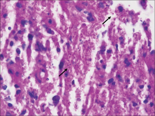 Hemophagocytic Lymphohistiocytosis due to Disseminated Histoplasmosis in a Patient with HIV Infection.