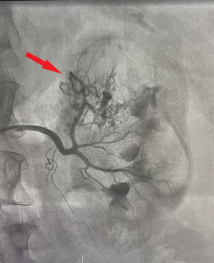 Endovascular management of bilateral renal angiomyolipoma in a perimenopausal woman.