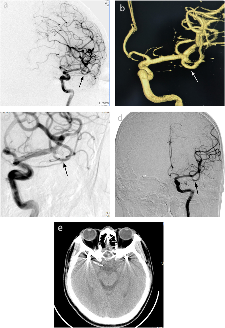 Mechanical compression management of the right middle cerebral artery inferior trunk using a stent during coil embolization of middle cerebral artery aneurysms: A case report and literature review