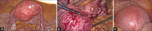 Surgical Morbidity of Laparoscopic Hysterectomy versus Abdominal Hysterectomy: A Retrospective Overview.